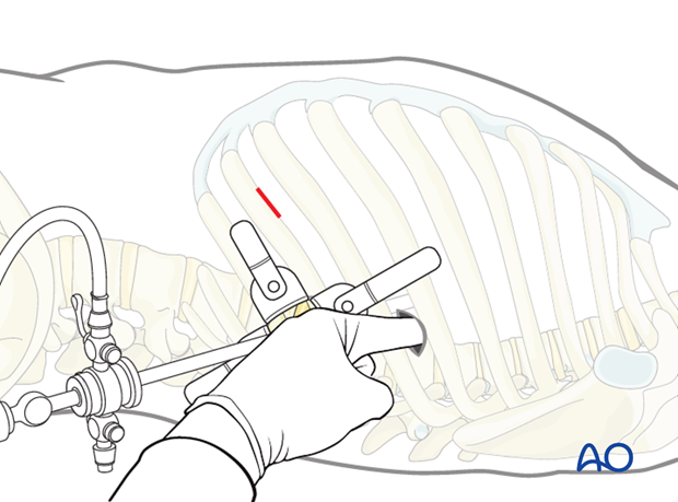 minimally invasive left side thoracic approach