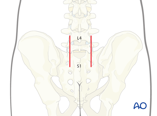 posterior fusion of l5 s1