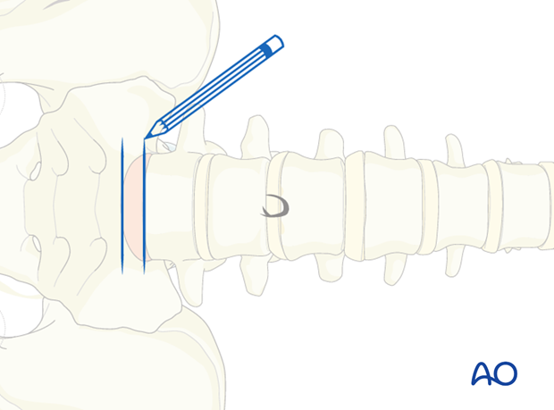 retroperitoneal approach