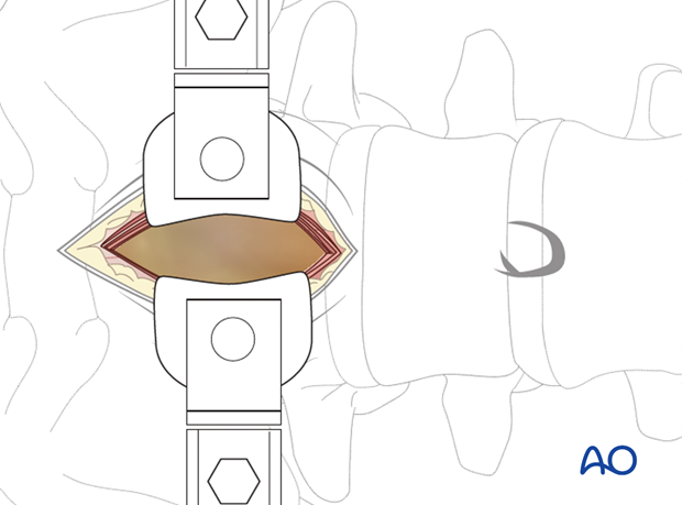 retroperitoneal approach