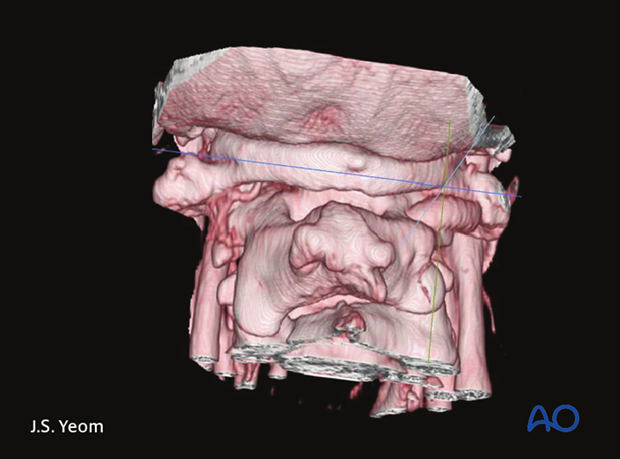 posterior access to the occipitocervical spine