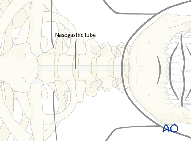 In addition to the tracheotube, a nasogastric tube should be inserted to identify better and thus help prevent accidental injury to the esophagus.