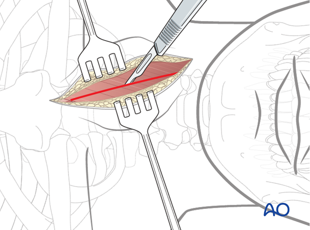 The platysma muscle is transected in line with the skin incision.