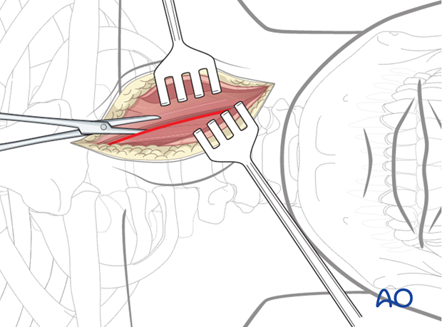 The deep cervical fascia is identified and divided along the anteromedial border of the sternocleidomastoid muscle.