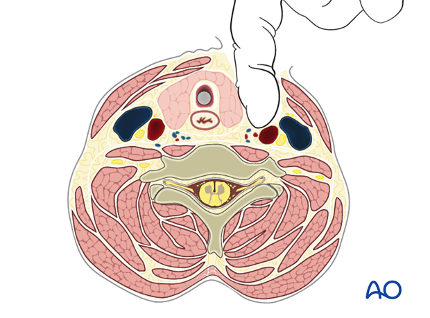 The carotid pulse is palpated, and the dissection is directed medial to the carotid sheath. 