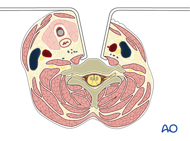 The prevertebral fascia is cut longitudinally, allowing direct visualization of the vertebra and the longus colli muscle.