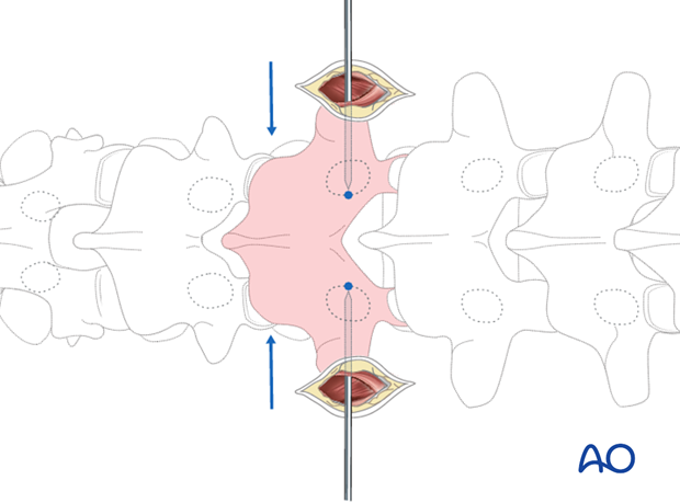 percutaneous pedicle screw insertion in the thoracolumbar spine