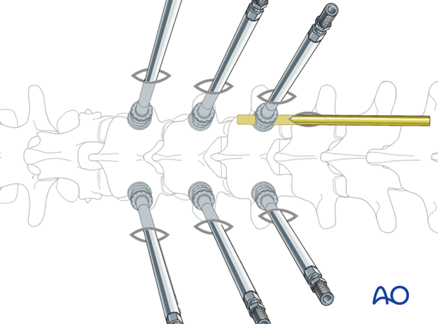 percutaneous pedicle screw insertion in the thoracolumbar spine