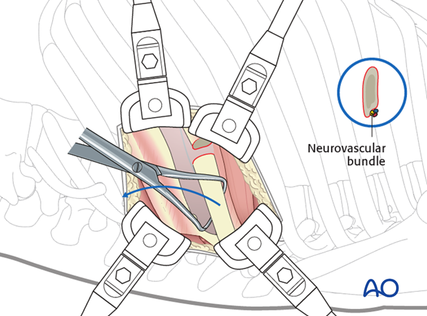 Thoracic and lumbar pathologies: Left sided thoracotomy (T3-L1/2)