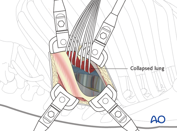 Thoracic and lumbar pathologies: Left sided thoracotomy (T3-L1/2)