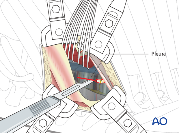 Thoracic and lumbar pathologies: Left sided thoracotomy (T3-L1/2)