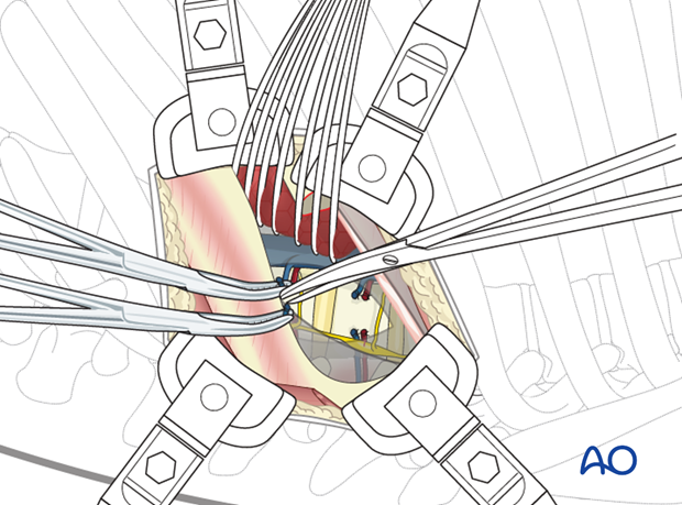 Thoracic and lumbar pathologies: Left sided thoracotomy (T3-L1/2)