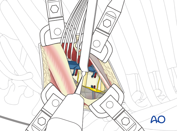 Thoracic and lumbar pathologies: Left sided thoracotomy (T3-L1/2)