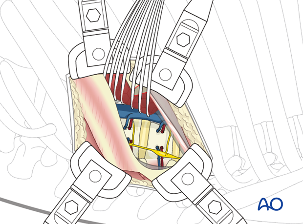 Thoracic and lumbar pathologies: Left sided thoracotomy (T3-L1/2)