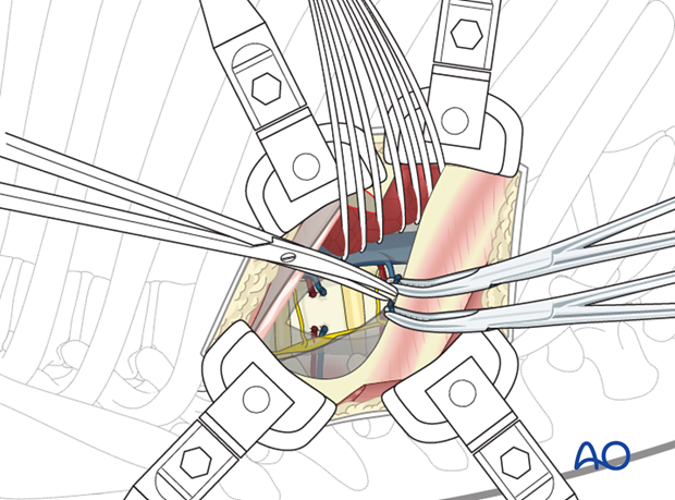 Thoracic and lumbar pathologies: Right sided thoracotomy (T3-T10)