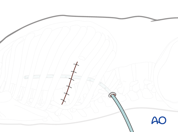 Thoracic and lumbar pathologies: Right sided thoracotomy (T3-T10)