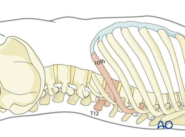 Thoracic and lumbar pathologies: Left sided thoracolumbar junction approach (T10-L2)