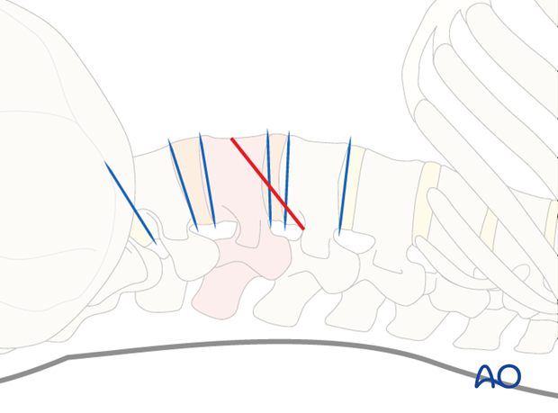 Thoracic and lumbar pathologies: Minimally invasive lumbotomy (L2-L4)