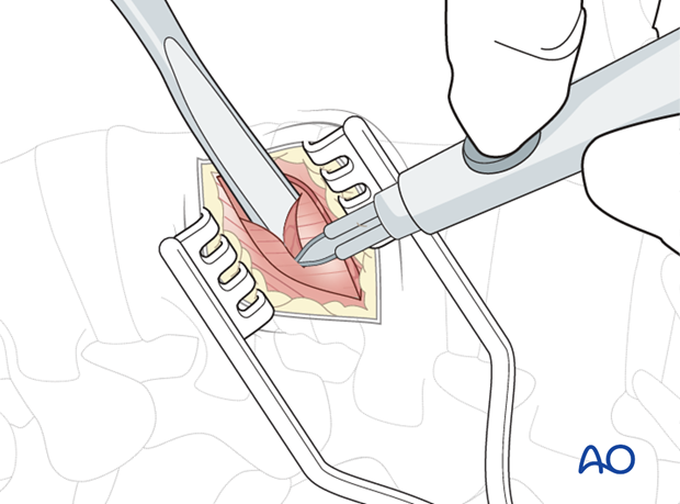 Thoracic and lumbar pathologies: Minimally invasive lumbotomy (L2-L4)