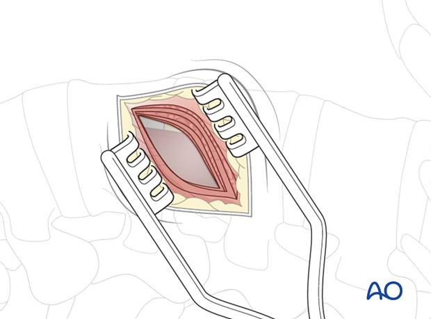 Thoracic and lumbar pathologies: Minimally invasive lumbotomy (L2-L4)