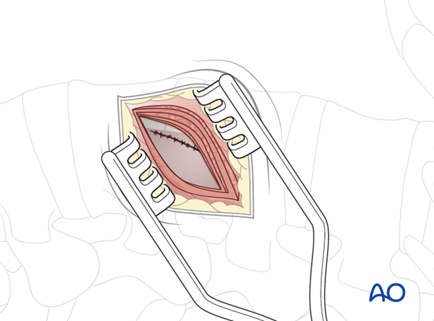 Thoracic and lumbar pathologies: Minimally invasive lumbotomy (L2-L4)