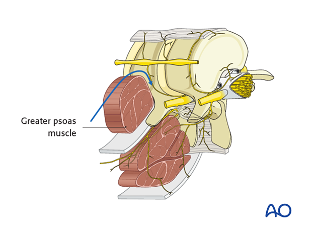 Thoracic and lumbar pathologies: Minimally invasive lumbotomy (L2-L4)