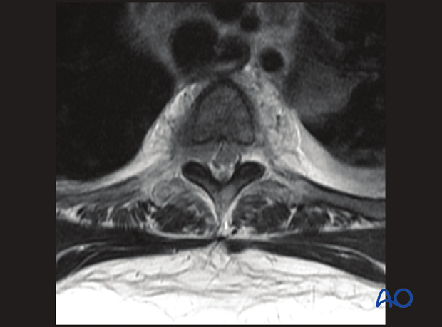 spinal cord compression scale