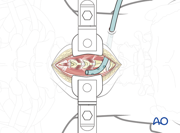 Insertion of drain during posterior access to the cervical spine