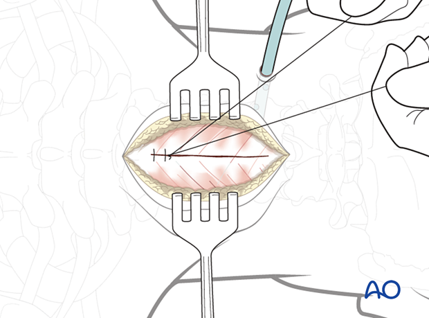 Closure of fascial layer during posterior access to the cervical spine