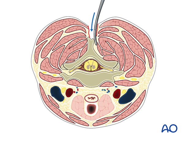 The paraspinal muscles are elevated subperiosteally 