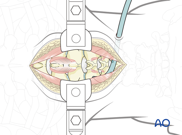 Drains are usually inserted via a separate stab incision