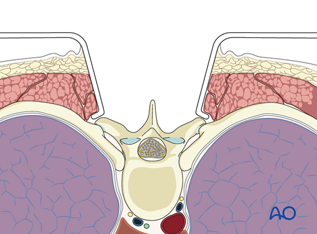 Dissection to the tips of the transverse processes during posterior midline access to the thoracolumbar spine