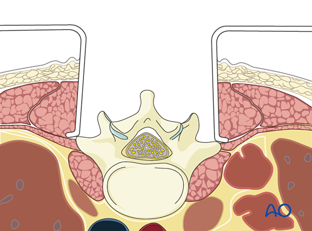 Dissection limited to the facet joints during posterior midline access to the thoracolumbar spine