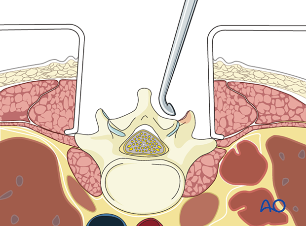 Excision of facet capsule and denusion of joint cartilage surfaces during posterior midline access to the thoracolumbar spine