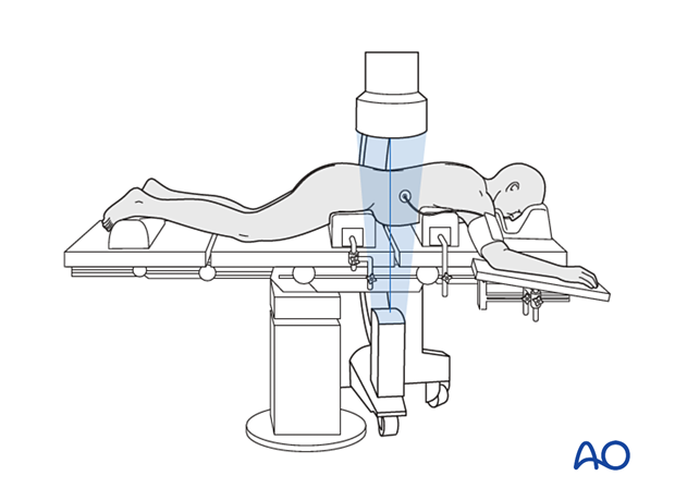 Checking spinal level during posterior midline access to the thoracolumbar spine