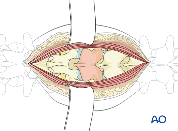 Posterior exposure of the thoracolumbar spine