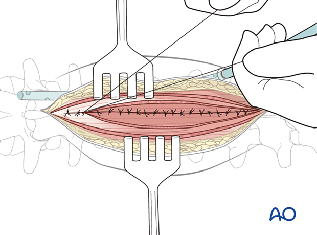 Tight closure of the muscle and fascial layer during posterior midline access to the thoracolumbar spine