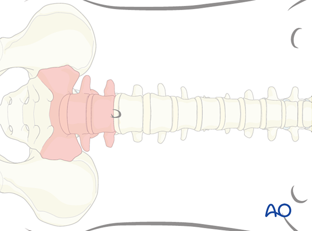 Thoracic and lumbar fractures: Mini open retroperitoneal approach (L4-S1)