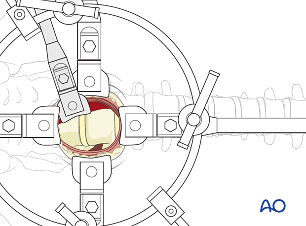 Thoracic and lumbar fractures: Mini open retroperitoneal approach (L4-S1)