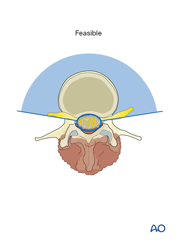 En bloc resection of a posterior tumor (L1 to L5) for Benign lumbar tumors