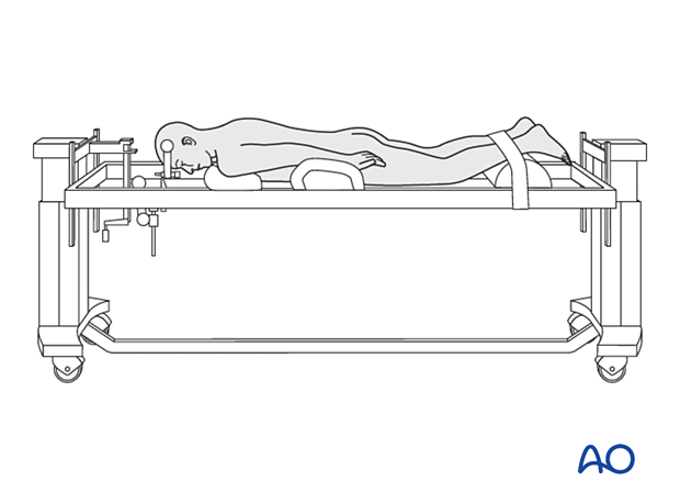 Prone patient position for T1–S5  