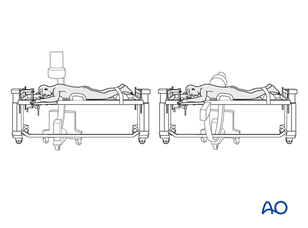 Put patient on a Jackson table with Mayfield pins: (this but with no straps, adding image intensifier)