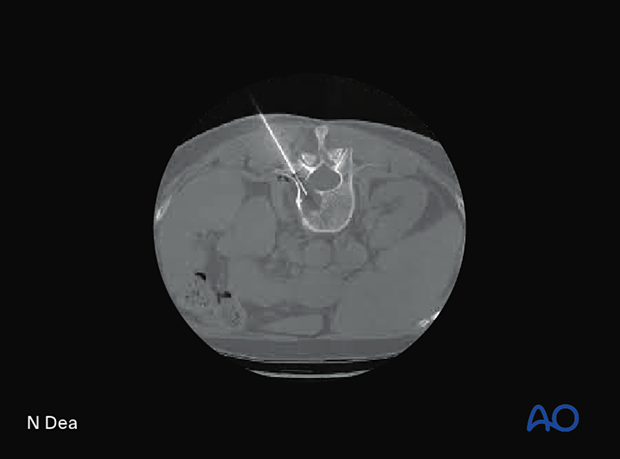 Biopsy of suspected primary tumor of the spine