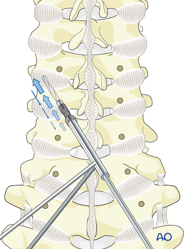 Drilling during lateral mass screw insertion magerl technique