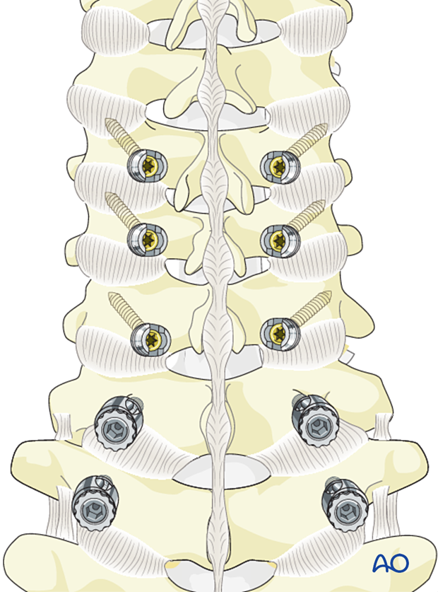 C7 and T1 should have a pedicle screw (last inferior), not a lateral mass