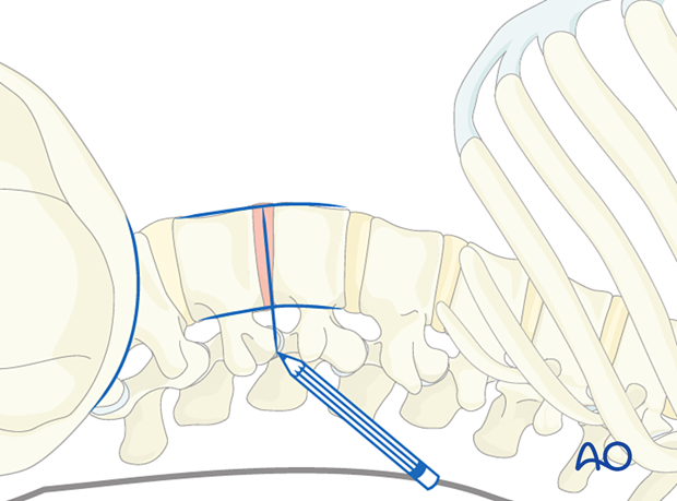 Marking disc space on the skin during a minimally invasive transpsoas approach