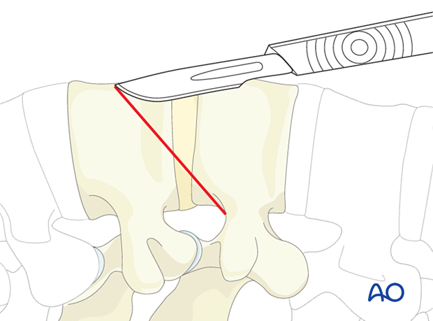 Making the incision during a minimally invasive transpsoas approach