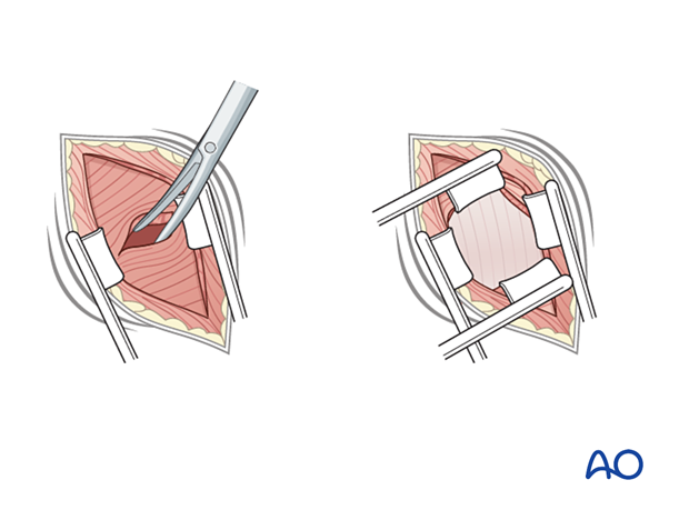 Splitting the internal abdominal oblique muscle during a minimally invasive transpsoas approach