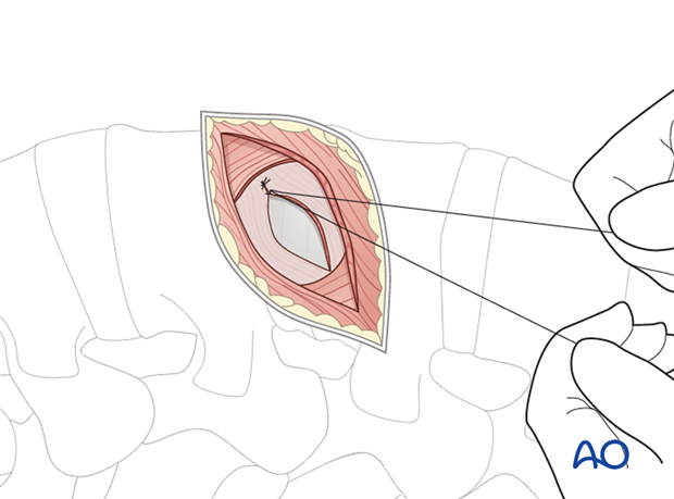 Closure of the fascia during the minimally invasive transpsoas approach