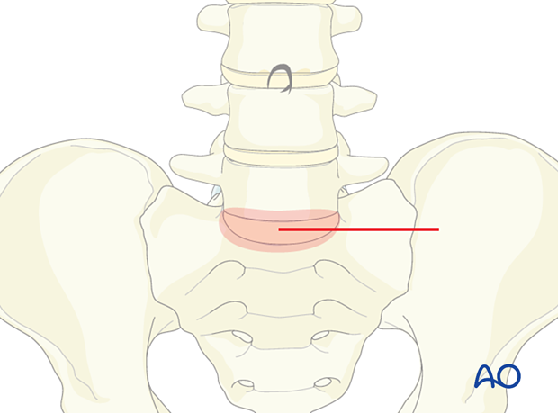 The skin incision during the Retroperitoneal approach for Anterior lumbar interbody fusion (ALIF)